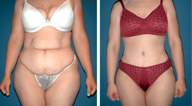 Abdominoplastía circular (Body lift)